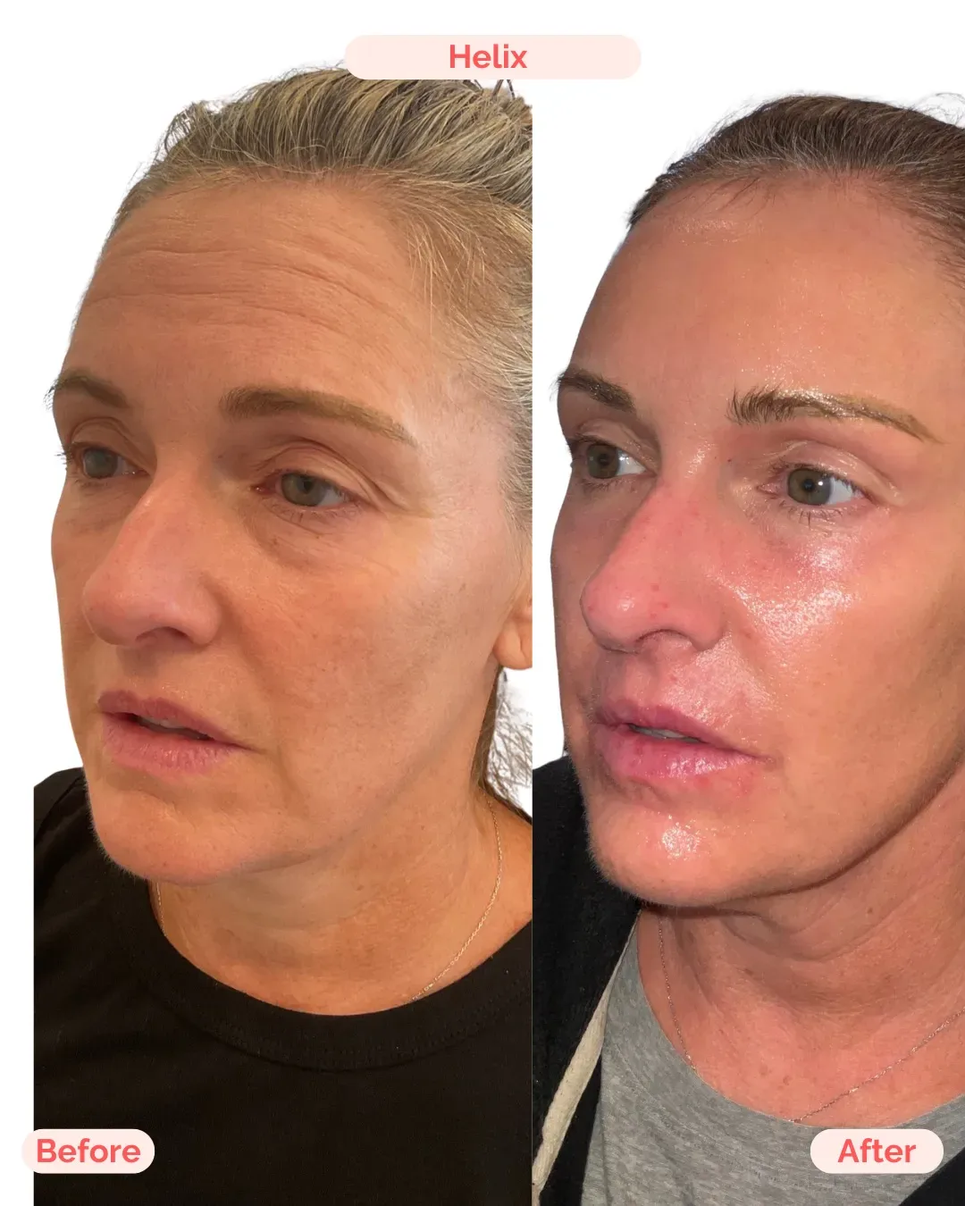 Skin Resurfacing Richmond VA