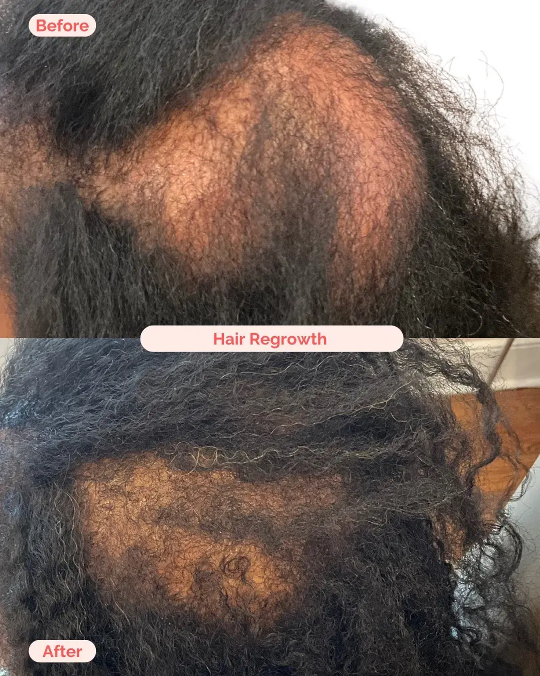 Hair Regrowth Treatment Richmond VA
