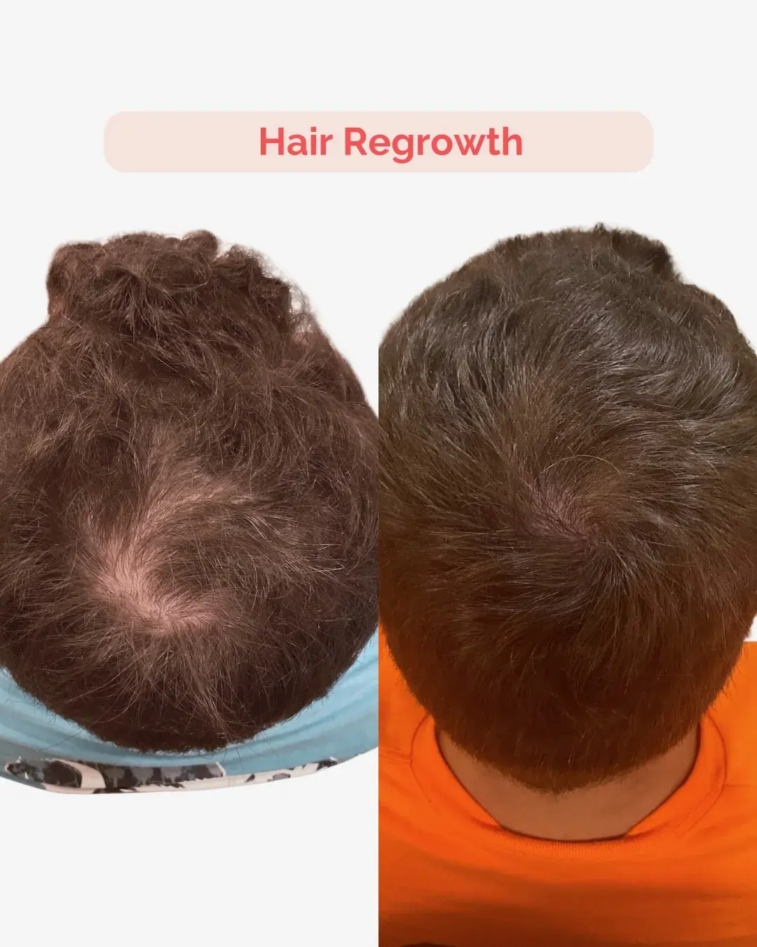 Hair Regrowth Treatment Richmond VA