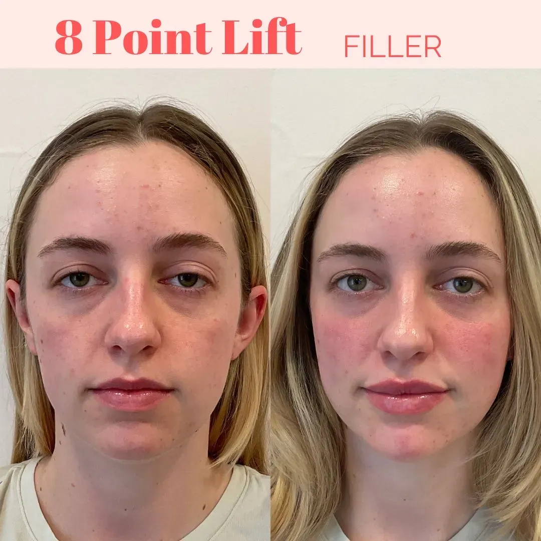 send-We addressed medial cheek, jaw, chin and lip filler_min